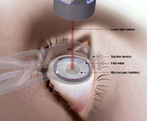 lasik-surgery