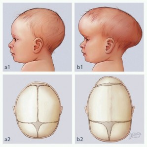 craniosynostosis