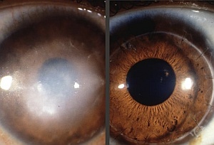 eyes-stem-cell