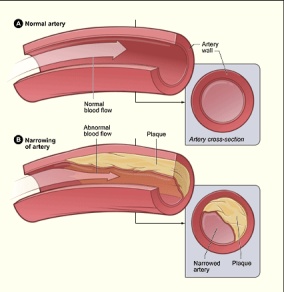 hardening-of-arties