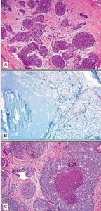 lobular-carcinoma-in-situ