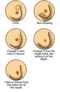 stages-of-breast-cancer