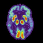 PET scan of a human brain with Alzheimer's disease