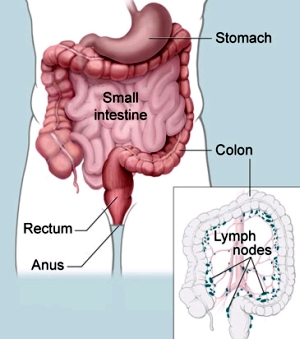 colon cancer