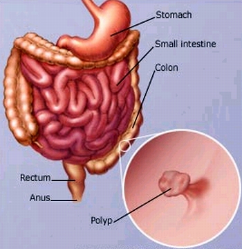 colon polyp