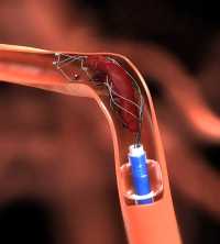 endovascular-thrombectomy