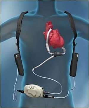 lvad